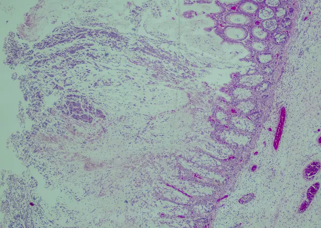 C. diff Cases Spike in the UK